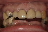 #1 lower-arch