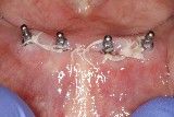 #15 multi-implants