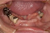 #2 interocclusal-space