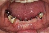 #3 interocclusal-space