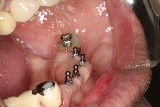 #4 mini-implants